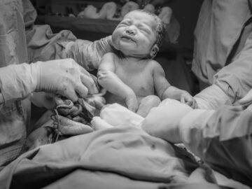 A newborn baby in a hospital delivery room, surrounded by medical practitioners during childbirth.