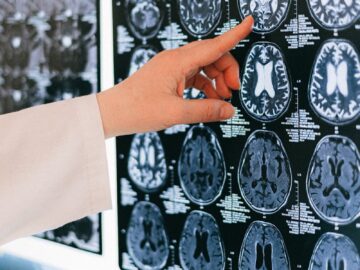 A doctor's hand points to a brain MRI scan on a lightbox, illustrating medical diagnosis.