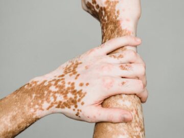 Detailed view of hands showing skin condition, highlighting unique patterns.