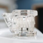 Transparent dental model showing teeth and implant screws, perfect for educational purposes.