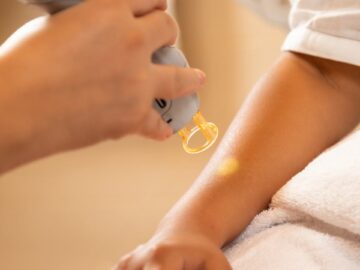 Close-up of a laser hair removal session at a spa, emphasizing professional skincare and relaxation.