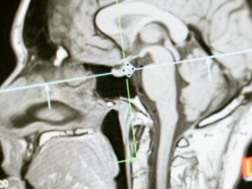 Close-up of an MRI scan showing a sagittal view of the human brain for analysis.