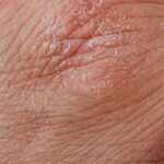 Detailed image highlighting dry, flaky skin texture for dermatological study.