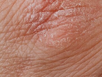 Detailed image highlighting dry, flaky skin texture for dermatological study.
