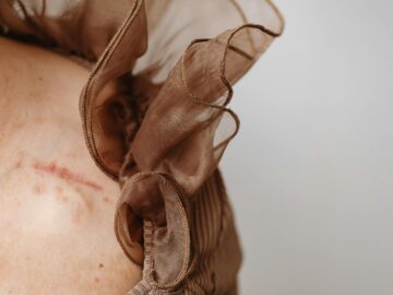 Close-up view of a scarred skin under sheer brown fabric, highlighting texture and detail.