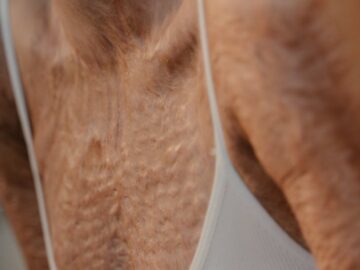 Close-up image highlighting skin texture and scars, focusing on the chest area in a brassiere.